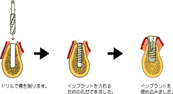 �C���v�����g��p