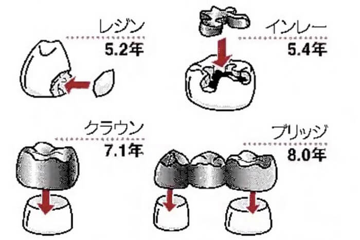 虫歯治療後の詰め物、かぶせ物の寿命（岡山大学・森田学教授）