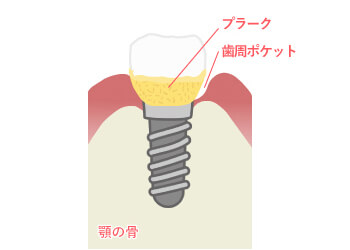 【3】進行した周囲炎