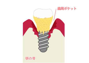 【2】軽度の周囲炎