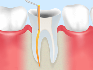 根管治療