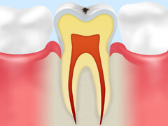 【CO】 ごく初期のむし歯