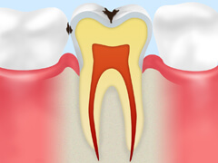 【C1】 エナメル質のむし歯