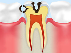【C2】 象牙質のむし歯