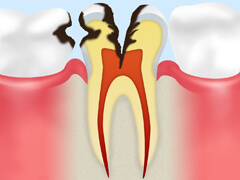 【C3】 神経に達したむし歯