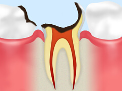 【C4】 歯根に達したむし歯