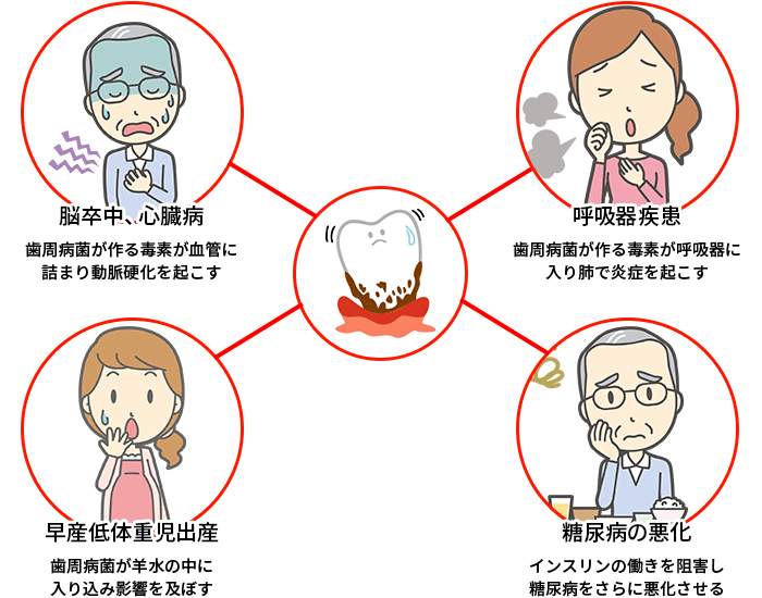 歯周病が及ぼす全身への影響について