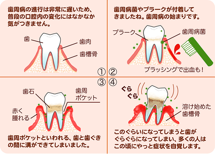 歯周病が及ぼす全身への影響について