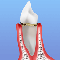 【STEP 02】　軽度歯周炎