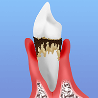 【STEP 04】　重度歯周炎