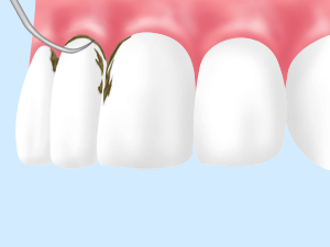 歯周病は、早期管理が最も大切です