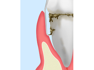 中等度歯周病～ルートプレーニング～